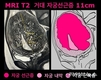 거대 자궁선근증, 자궁적출 없이 하이푸로 치료 가능할까?
