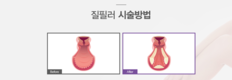 Y존 건강 위한 질필러 등 여성성형 진행시 주의점은